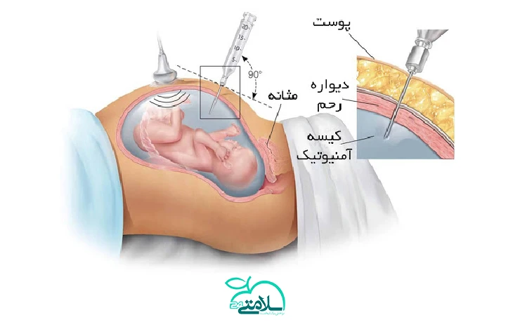 تمام آنچه که باید درباره آمنیوسنتز بدانید